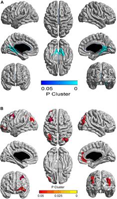 Alterations in Cortical Thickness in Young Male Patients With Childhood-Onset Adult Growth Hormone Deficiency: A Morphometric MRI Study